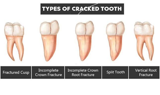 CRACKED TOOTH