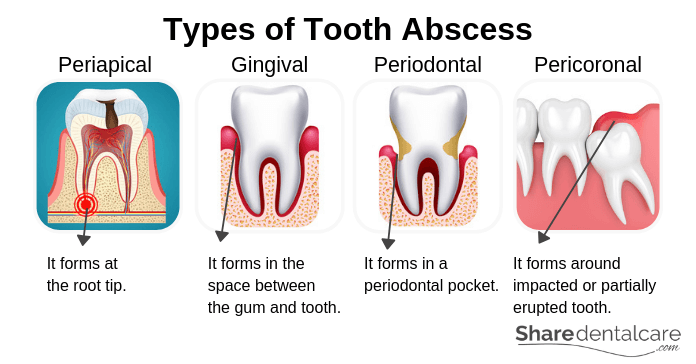 abscess gum