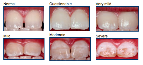 dental fluorosis 1