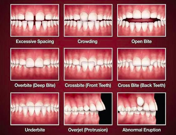 Types Of Malocclusion Of Teeth